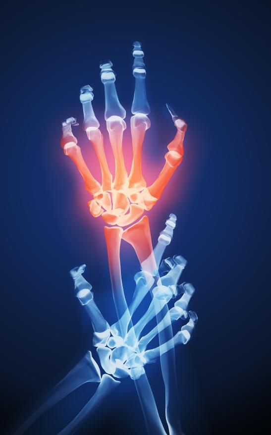 Arthritis Treatment